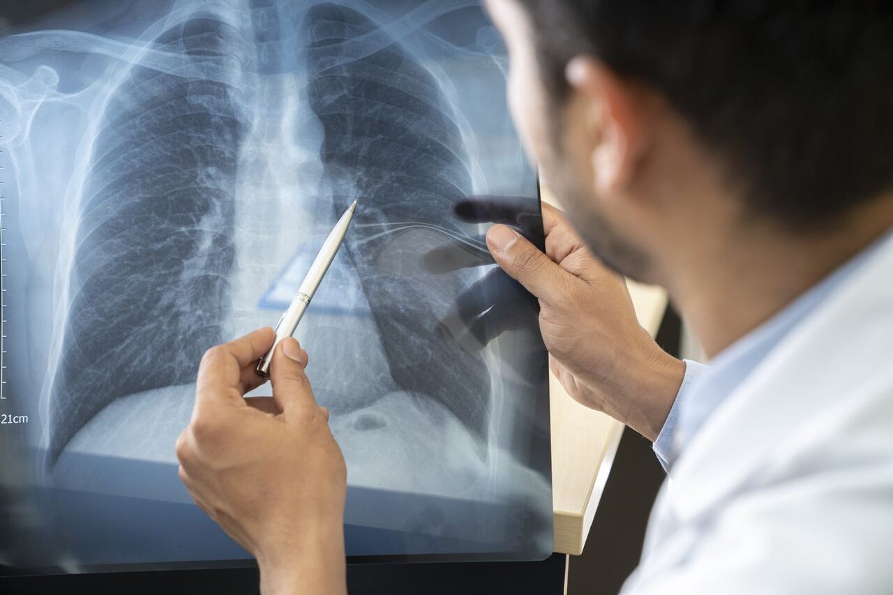 etapas del c&aacute;ncer de pulm&oacute;n