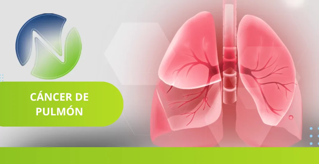 Comprender el c&aacute;ncer de pulm&oacute;n diagn&oacute;stico, s&iacute;ntomas y tratamientos